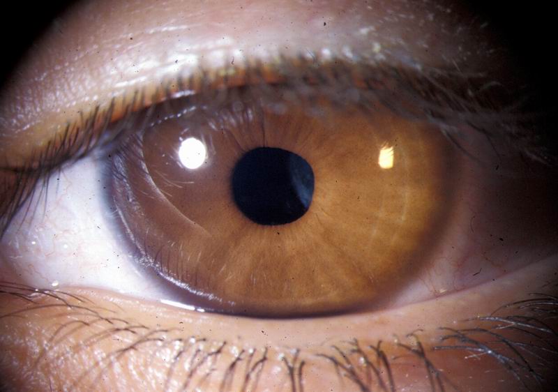Ectopia Lentis et Pupillae Hereditary Ocular Diseases